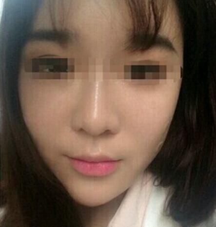 在濟(jì)南吉芙醫(yī)院做的玻尿酸填充淚溝，填充淚溝圖片分享