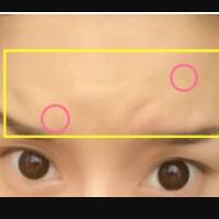 注射瘦臉去抬頭紋果不錯——濟南吉芙美容整形醫(yī)院