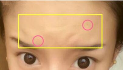 注射瘦臉去抬頭紋果不錯——濟(jì)南吉芙美容整形醫(yī)院