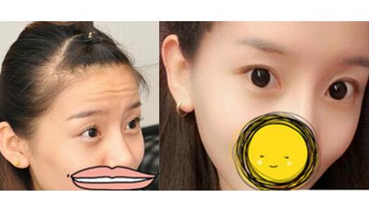 注射瘦臉去抬頭紋果不錯——濟(jì)南吉芙美容整形醫(yī)院