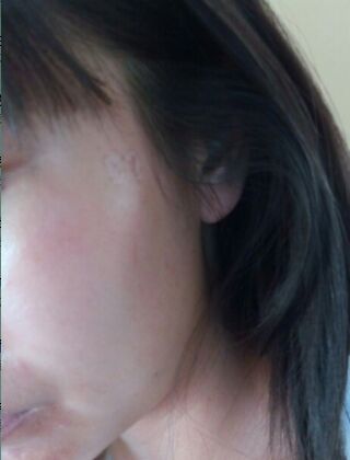 激光去咖啡斑恢復過程，福州美貝爾真實案例