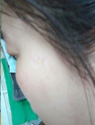 激光去咖啡斑恢復過程，福州美貝爾真實案例