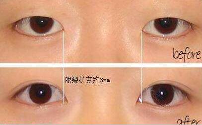 開眼角+割雙眼皮，眼睛整形價格表曝光