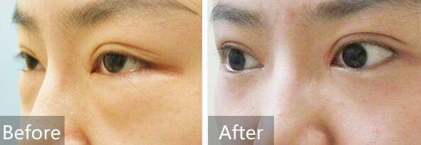 去眼袋前后對比圖，去眼袋價格