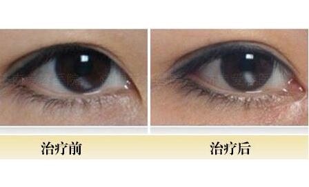 開內(nèi)眼角前后對比圖，眼睛整形價格
