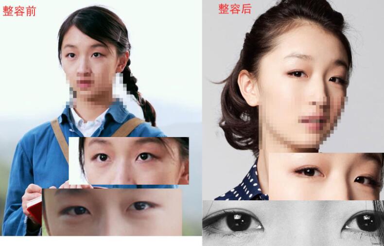 周冬雨割單眼皮前后對比圖，單眼皮割雙眼皮價(jià)格和果圖