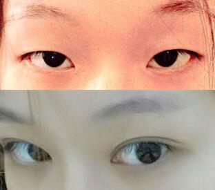 單眼皮割雙眼皮價(jià)格和果圖