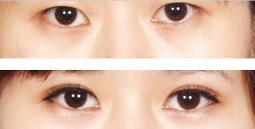 單眼皮割雙眼皮價(jià)格和果圖
