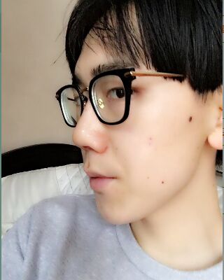 男生隆鼻整形案例分享，福州美貝爾張潮做的