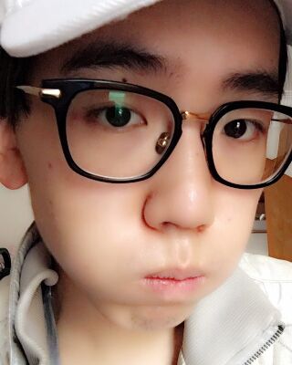 男生隆鼻整形案例分享，福州美貝爾張潮做的