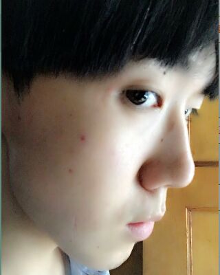 男生隆鼻整形案例分享，福州美貝爾張潮做的