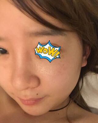 第(一)次激光去雀斑果圖，貴陽美萊劉紅武做的