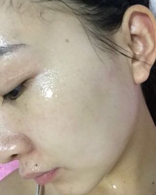 第(一)次激光去雀斑果圖，貴陽美萊劉紅武做的