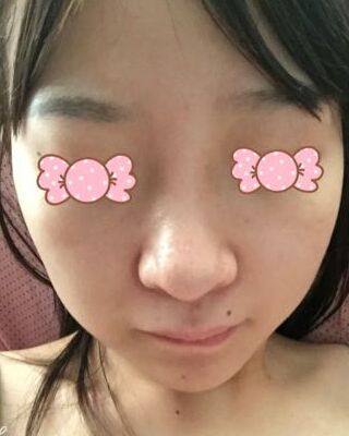 第(一)次激光去雀斑果圖，貴陽美萊劉紅武做的