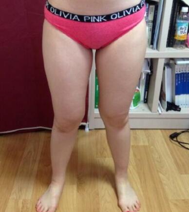 抽脂減肥瘦大腿價格10800元，一個月后恢復很好