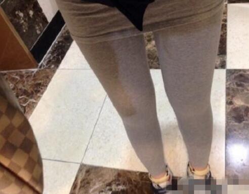 抽脂減肥瘦大腿價格10800元，一個月后恢復很好