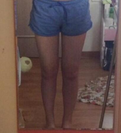 抽脂減肥瘦大腿價格10800元，一個月后恢復很好