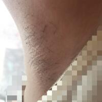 激光脫毛的價格380元，圖片分享