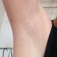 激光脫毛的價格380元，圖片分享