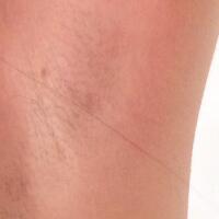 激光脫毛的價格380元，圖片分享