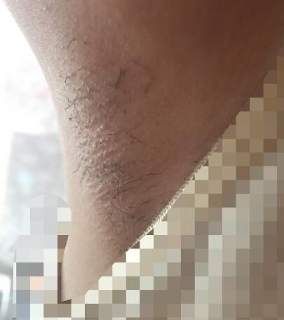 激光脫毛的價(jià)格380元，激光脫毛圖片分享