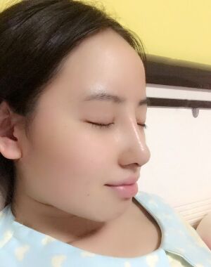 貴陽美萊梁潔隆鼻整形兩個月果圖