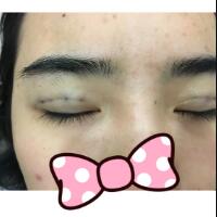 埋線雙眼皮恢復(fù)日志多對(duì)比圖分享