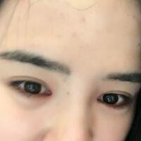 埋線雙眼皮恢復(fù)日志多對(duì)比圖分享