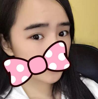 埋線雙眼皮恢復(fù)日志多對(duì)比圖分享