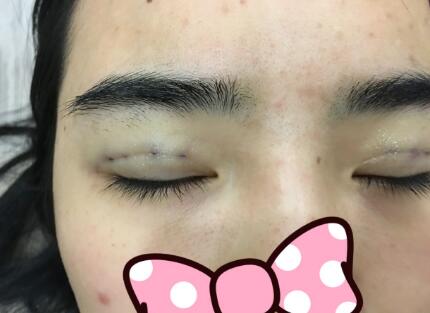 埋線雙眼皮恢復(fù)日志多對(duì)比圖分享