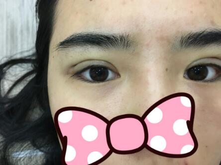 埋線雙眼皮恢復(fù)日志多對(duì)比圖分享