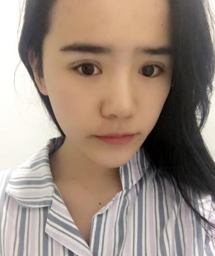 埋線雙眼皮恢復(fù)日志多對(duì)比圖分享