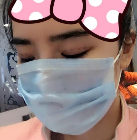 埋線雙眼皮恢復(fù)日志多對(duì)比圖分享