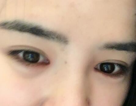 埋線雙眼皮恢復(fù)日志多對(duì)比圖分享