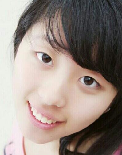 見證全切雙眼皮使單眼皮變雙眼皮的奇跡~恢復(fù)過程圖分享