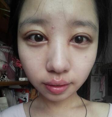 見證全切雙眼皮使單眼皮變雙眼皮的奇跡~恢復(fù)過程圖分享