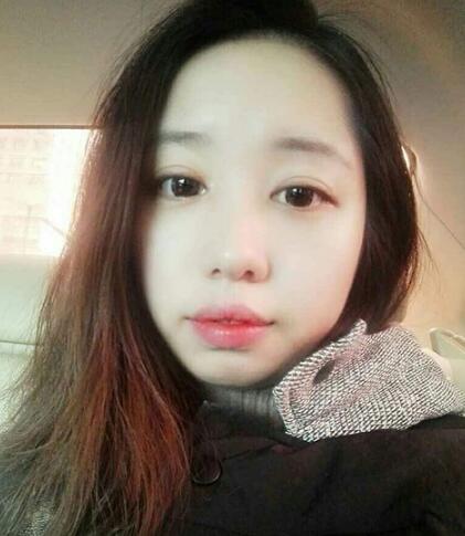 見證全切雙眼皮使單眼皮變雙眼皮的奇跡~恢復(fù)過程圖分享