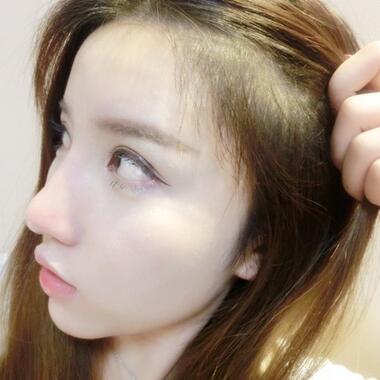 廣州倍生發(fā)際線種植前后對比照片