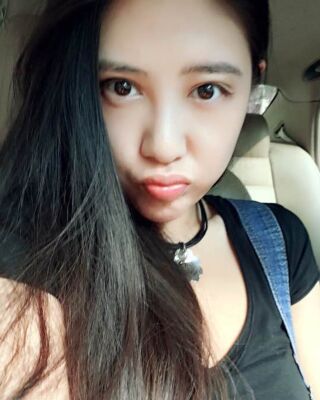 貴陽麗都自體脂肪面部填充+雙下巴吸脂恢復(fù)圖片