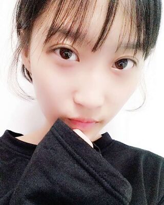 微創(chuàng)全切雙眼皮果對比照片，貴陽麗都葛志鑫手術(shù)案例