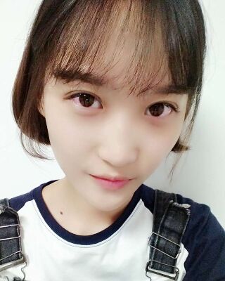 微創(chuàng)全切雙眼皮果對比照片，貴陽麗都葛志鑫手術(shù)案例