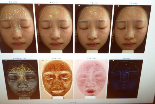 有人做過光子嫩膚嗎？自己做過，感覺果不錯分享