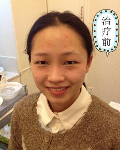 有人做過光子嫩膚嗎？自己做過，感覺果不錯分享