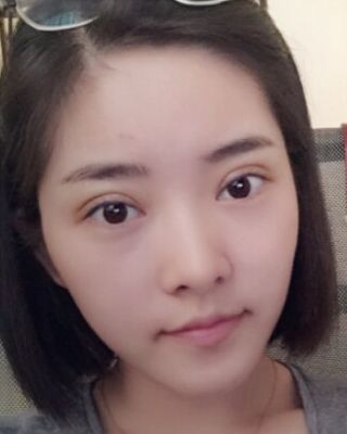 全切微創(chuàng)雙眼皮恢復(fù)圖，長(zhǎng)沙希美蔣松林手術(shù)案例