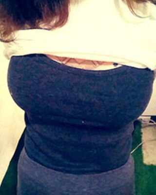 長沙希美假體隆胸前后對比果圖，A到C的變化