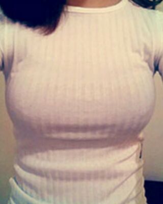 長沙希美假體隆胸前后對比果圖，A到C的變化