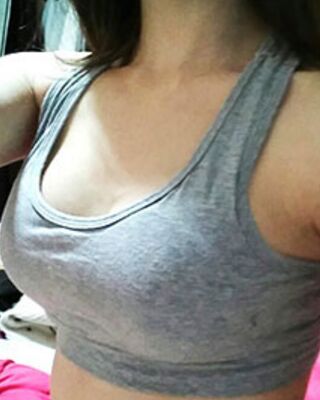 長沙希美假體隆胸前后對比果圖，A到C的變化