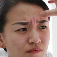 注射瘦臉去抬頭紋眉間紋恢復(fù)過程圖，真實案例分享