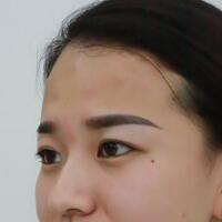 注射瘦臉去抬頭紋眉間紋恢復(fù)過程圖，真實案例分享