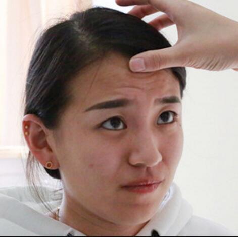 注射瘦臉去抬頭紋眉間紋恢復(fù)過程圖，真實(shí)案例分享